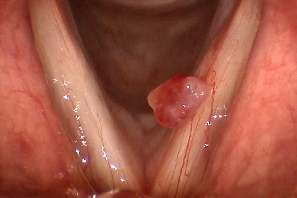 Vocal Polyps Picture