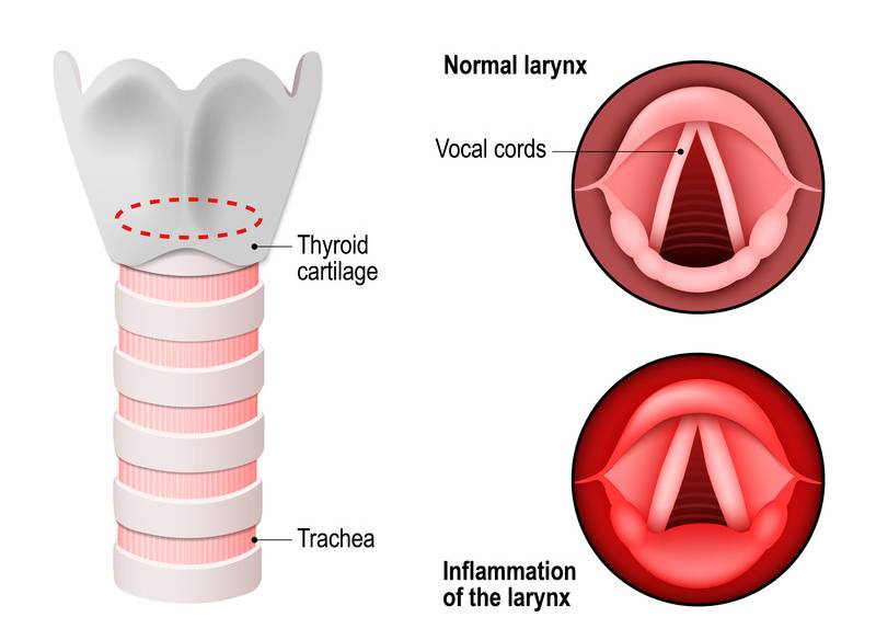 Laryngitis Diagram