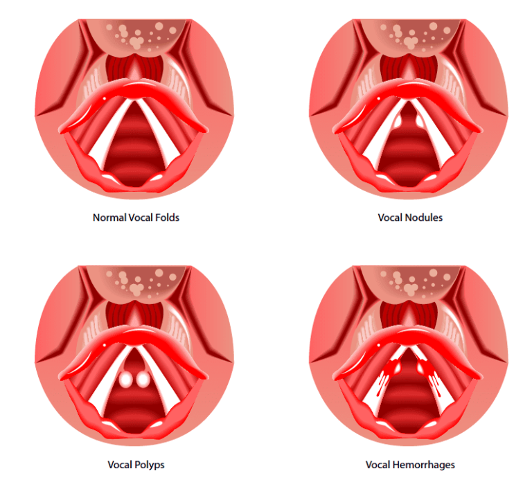 Vocal Health for Singers: Preventing and Recovering from Vocal Damage ...