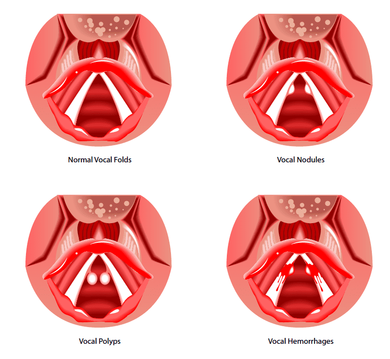Vocal Hemorrhage
